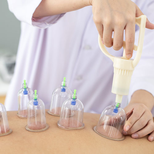 cupping-therapy-image
